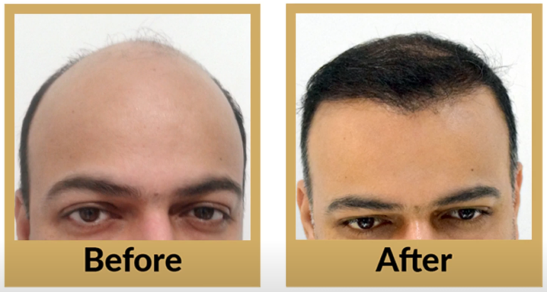 -64-DermaDent-Clinic-Udaipur-Hair-Transplant-Feedback-by-our-esteemed-patient-YouTube-03-15-2025_09_01_AM