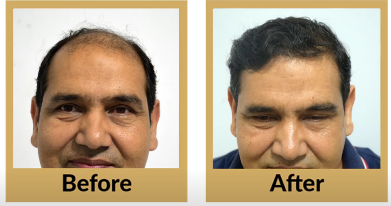 -64-Life-Changing-Hair-Transplant-Results-by-DermaDent-Clinic-Udaipur-Patient-s-Testimonials-Udaipur-YouTube-03-15-2025_08_59_AM